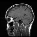 x-ray of brain and skull